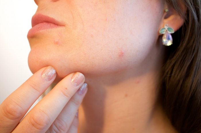 Dieta e acne: come risolvere il problema